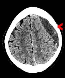 brainscan